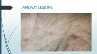 JANEWAY LESIONS
 