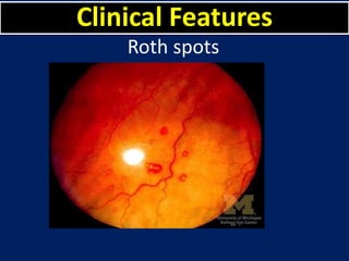 Infective endocarditis | PPTX
