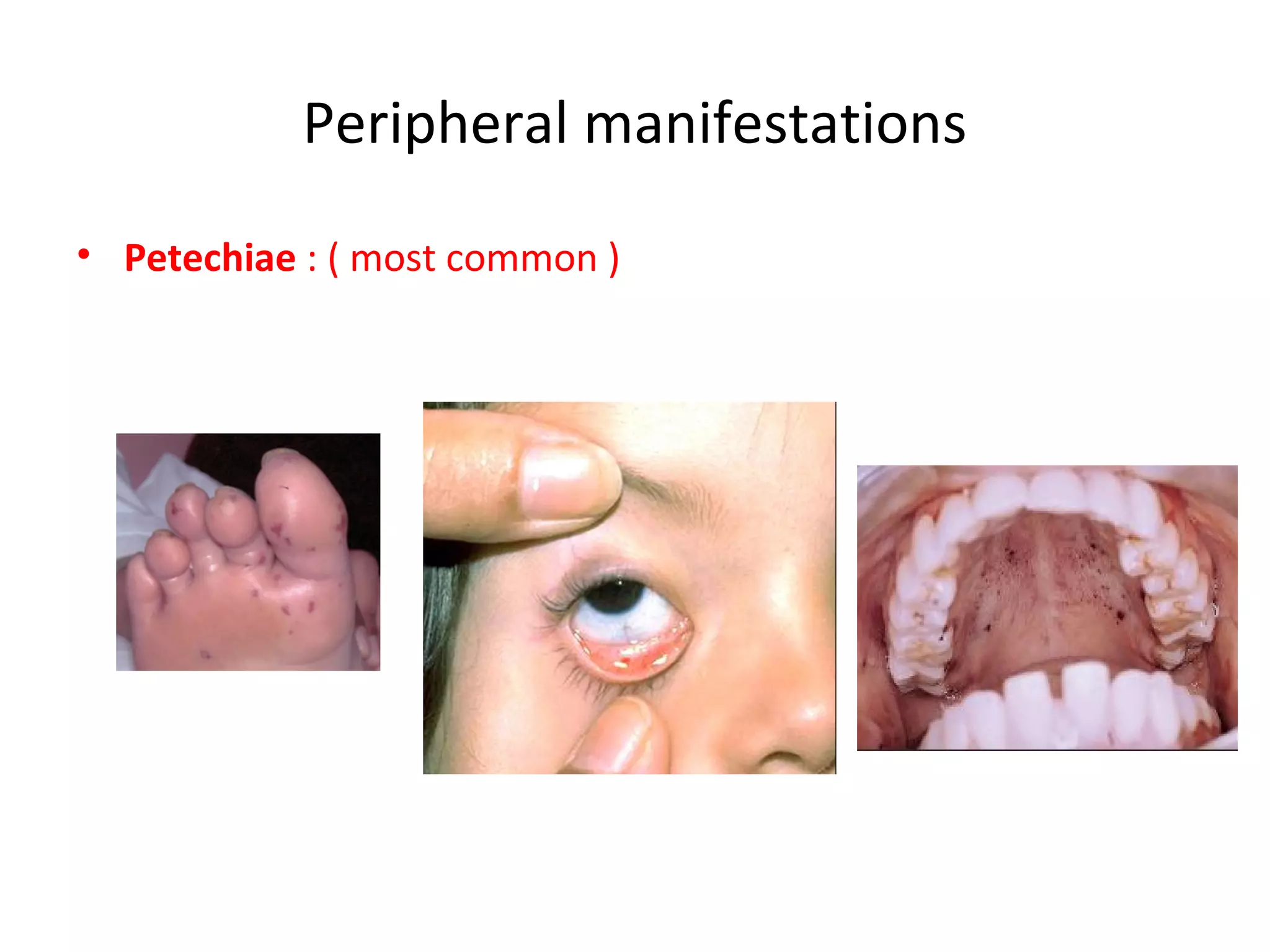 Infective endocarditis | PPT | Heart and Cardiovascular Diseases