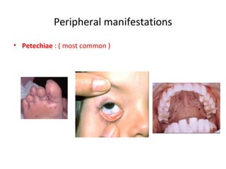 Peripheral manifestations
• Petechiae : ( most common )
 