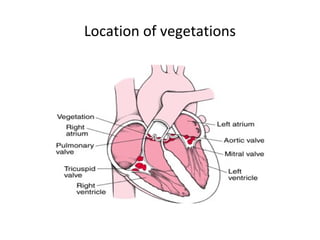 Location of vegetations
 