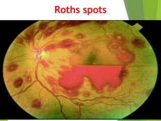 Infective endocarditis | PPTX
