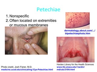 Infective endocarditis | PPT
