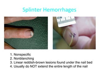 Infective endocarditis | PPT
