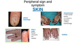 Peripheral sign and
symptom
SKIN
Splinter
hemorhage
Janeway lesion
>> Non-tender
lesions
>> 1-4 mm in
diameter
>>Often
haemorrhagic
Osler’s
nodes
Painful
subcutane
ous
nodules
Clubbing
 