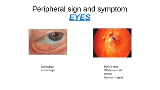Peripheral sign and symptom
EYES
Conjuctival
hemorhage
Roth’s spot
White centred
retinal
haemorrhages)
 