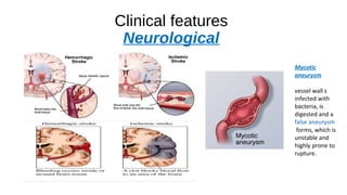 Clinical features
Neurological
Mycotic
aneurysm
vessel wall s
infected with
bacteria, is
digested and a
false aneurysm
forms, which is
unstable and
highly prone to
rupture.
 