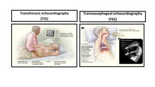 Transthoracic echocardiography
(TTE)
Transoesophageal echocardiography
(TEE)
 