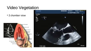 Video Vegetation
• 2 chamber view
 