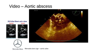 Video – Aortic abscess
Mercedes benz sign – aortic valve
 