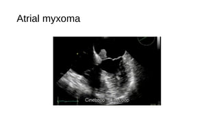 Atrial myxoma
 