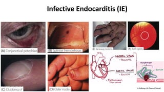 Infective Endocarditis (IE)
 