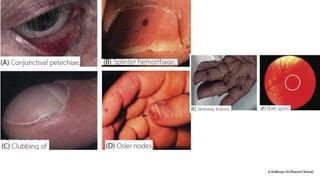 Infective endocarditis (IE)