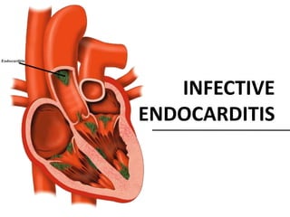 INFECTIVE
ENDOCARDITIS
 