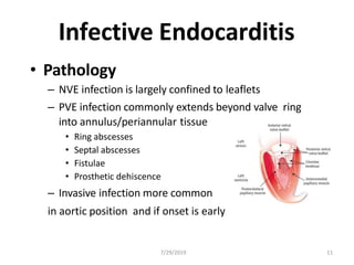 Infective Endocarditis
7/29/2019 11
• Pathology
– NVE infection is largely confined to leaflets
– PVE infection commonly extends beyond valve ring
into annulus/periannular tissue
• Ring abscesses
• Septal abscesses
• Fistulae
• Prosthetic dehiscence
– Invasive infection more common
in aortic position and if onset is early
 