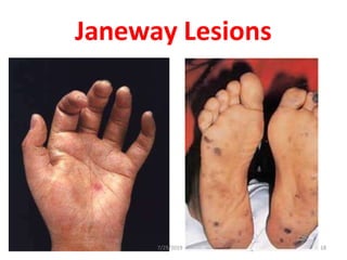 Janeway Lesions
7/29/2019 18
 
