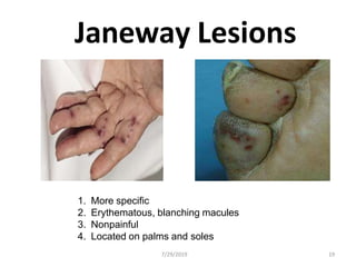 Janeway Lesions
1. More specific
2. Erythematous, blanching macules
3. Nonpainful
4. Located on palms and soles
7/29/2019 19
 