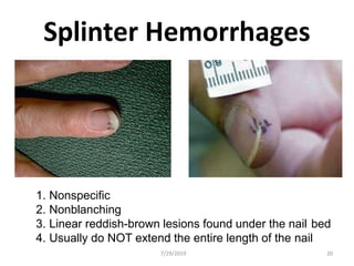 Splinter Hemorrhages
1. Nonspecific
2. Nonblanching
3. Linear reddish-brown lesions found under the nail bed
4. Usually do NOT extend the entire length of the nail
7/29/2019 20
 