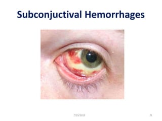 Subconjuctival Hemorrhages
7/29/2019 21
 