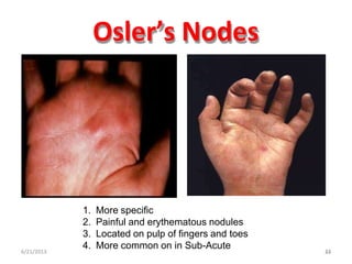 Osler’s Nodes
6/21/2013
1. More specific
2. Painful and erythematous nodules
3. Located on pulp of fingers and toes
4. More common on in Sub-Acute 3223
 