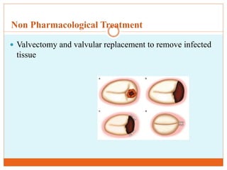 Non Pharmacological Treatment
 Valvectomy and valvular replacement to remove infected
tissue
 