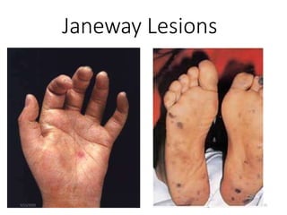 Janeway Lesions
5/11/2020 22
1. More specific
2. Erythematous, blanching macules
3. Nonpainful
4. Located on palms and sol...