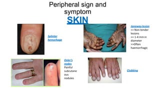 Infective endocarditis | PPTX