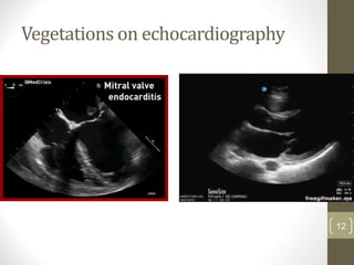 Vegetations on echocardiography
12
 