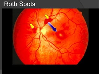 Infective Endocarditis.ppt