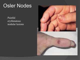 Infective Endocarditis.ppt