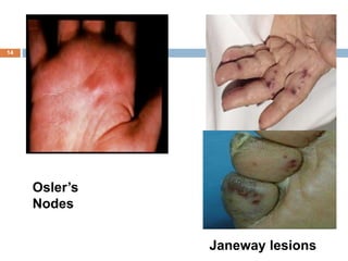 14
 Janeway Lesions
Janeway lesions
Osler’s
Nodes
 