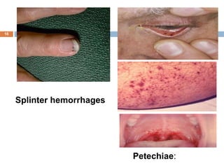 16
Splinter hemorrhages
Petechiae:
 