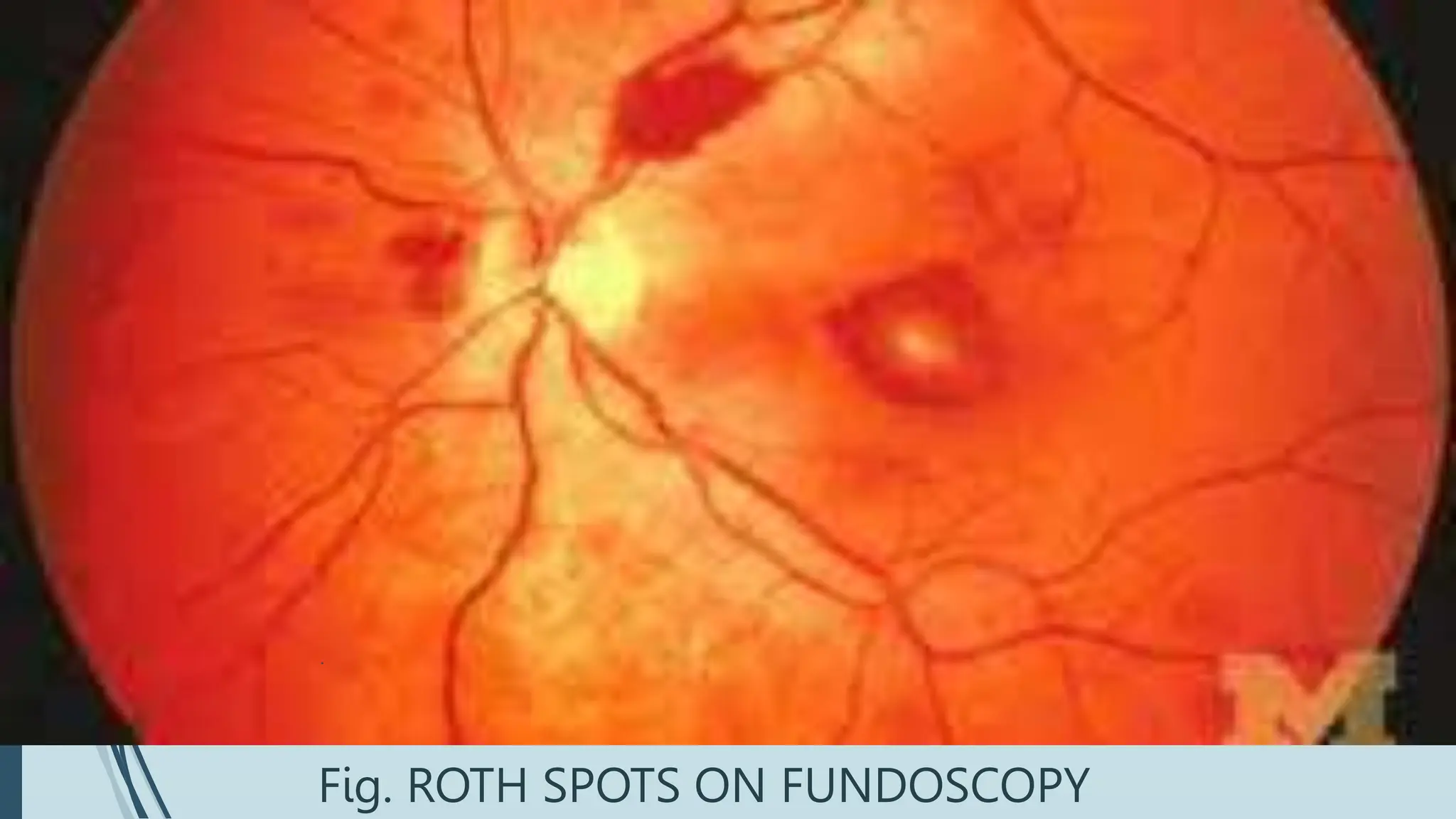 Old Roth Spots INFECTIVE ENDOCARDITIS.pptx by Dr. Humna | PPTX