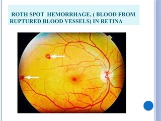 Inverse Roth Spot Infective Endocarditis related slide which contain all the information ...