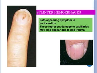 Infective Endocarditis related slide which contain all the information ...