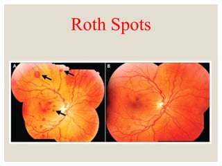 Inverse Roth Spot Infective Endocarditis and its presentation and management.ppt
