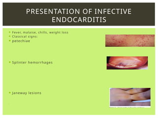 INFECTIVE ENDOCARDITIS notes for learning | PPTX