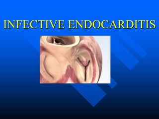 INFECTIVE ENDOCARDITIS
 