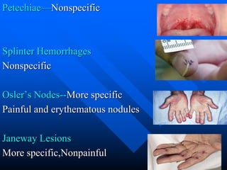 Petechiae—Nonspecific
Splinter Hemorrhages
Nonspecific
Osler’s Nodes--More specific
Painful and erythematous nodules
Janeway Lesions
More specific,Nonpainful
 