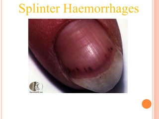 Splinter Haemorrhages
 