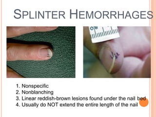 SPLINTER HEMORRHAGES
1. Nonspecific
2. Nonblanching
3. Linear reddish-brown lesions found under the nail bed
4. Usually do NOT extend the entire length of the nail
23
 