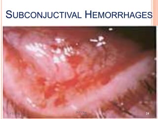 SUBCONJUCTIVAL HEMORRHAGES
6/21/2013
Dr.T.V.Rao
MD
24
 