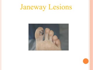 Janeway Lesions
 