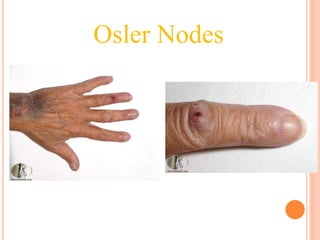 Osler Nodes
 