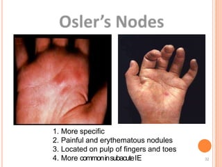 1. More specific
2. Painful and erythematous nodules
3. Located on pulp of fingers and toes
4. More commoninsubacuteIE 32
 