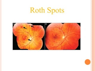 Roth Spots
 