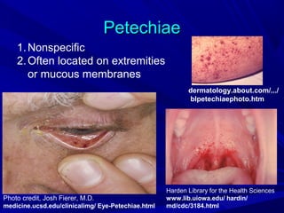 Petechiae
1. Nonspecific
2. Often located on extremities
or mucous membranes
dermatology.about.com/.../
blpetechiaephoto.htm

Photo credit, Josh Fierer, M.D.
medicine.ucsd.edu/clinicalimg/ Eye-Petechiae.html

Harden Library for the Health Sciences
www.lib.uiowa.edu/ hardin/
md/cdc/3184.html

 