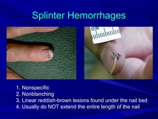 Splinter Hemo Infective endocarditis-1 | PPT
