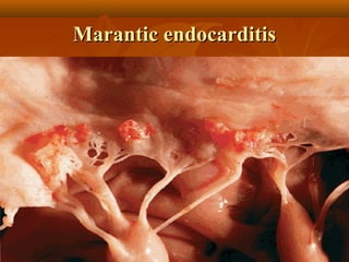 Marantic endocarditisMarantic endocarditis
 