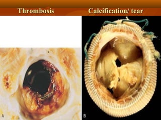 Thrombosis Calcification/ tearThrombosis Calcification/ tear
 